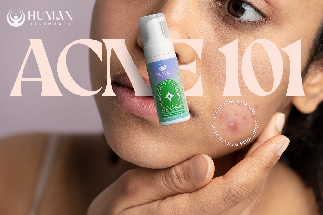 Types of Acne Explained: Find the Right Treatment for Your Skin